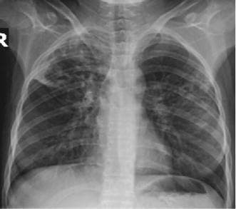 This diagnostic image is a posterior-anterior (PA) chest radiograph illustrating pulmonary manifestations of multi-drug resistant tuberculosis (MDR-TB). The radiograph reveals significant pathology characterized by bilateral, asymmetric opacities and infiltrates, predominantly involving the upper and mid-lung zones. Specifically, there are dense, patchy alveolar and interstitial infiltrates visible in both apical regions. Within these areas of consolidation, several lucent, thin-walled cavitary lesions are present, which are classic radiographic hallmarks of post-primary or secondary tuberculosis reactivation. The mediastinal shadow appears within normal limits, and there is no evidence of significant pleural effusion. The visible skeletal structures show no acute fractures, though the clinical context notes an underlying diagnosis of systemic lupus erythematosus (SLE), which may contribute to the patient's immunosuppression. This image serves as an educational example of advanced pulmonary infectious disease and the radiographic appearance of cavitation in the setting of drug-resistant mycobacterial infection.