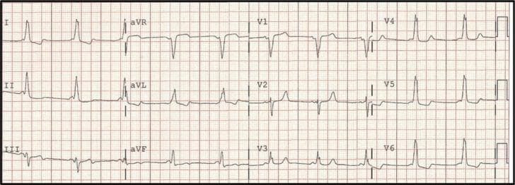 A standard 12-lead electrocardiogram (ECG) tracing demonstrating classic features of manifest ventricular pre-excitation, characteristic of Wolff-Parkinson-White (WPW) syndrome. The primary diagnostic findings include a shortened PR interval (<120 ms) and a widened QRS complex with a distinctive 'delta wave,' visible as initial slurring or notching of the QRS upstroke. These features are most prominent in the precordial leads (V1-V6) and lateral limb leads. The polarity of the delta waves—specifically the negative delta wave in lead III and a predominantly positive QRS in leads V4-V6—is consistent with a mid-septal accessory pathway location. The rhythm is a regular sinus rhythm, and secondary ST-T wave changes are visible, which are common in pre-excitation due to altered ventricular depolarization. This diagnostic image is essential for medical students and clinicians studying cardiac electrophysiology and the interpretation of tachyarrhythmia substrates.