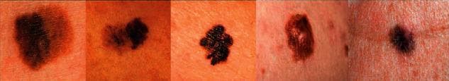 This clinical photograph montage displays five separate skin lesions, primarily identified as melanocytic lesions or potential melanomas, sourced from the SIIM-ISIC Melanoma dataset. The series illustrates the ABCDE criteria used in dermatology (Asymmetry, Border irregularity, Color variegation, Diameter, and Evolution). The lesions range from dark brown to deep black and exhibit significant morphological diversity. Key visual features include: (1) an asymmetrical macule with indistinct, smudged borders; (2) a multi-lobed lesion with notched margins; (3) a highly irregular, pigmented plaque with a textured, verrucous surface; (4) a lesion showing varied shades of brown and tan with erythematous surrounding skin; and (5) a smaller, focal dark nodule. These images are utilized in the context of computer-aided diagnostic research for skin cancer identification, specifically focusing on lesion segmentation and classification using deep learning algorithms. The educational focus is on identifying visual hallmarks of malignancy, such as pigment variegation and irregular border definition.