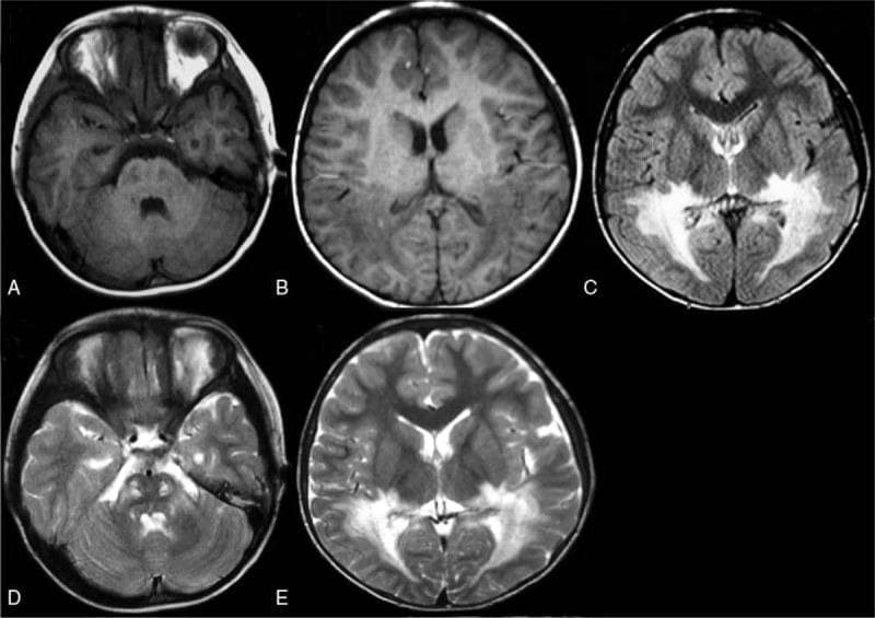 This diagnostic imaging panel consists of axial brain MRI sequences (A-E) illustrating characteristic white matter lesions associated with X-linked adrenoleukodystrophy (X-ALD). The panel includes T1-weighted (A, B), Fluid-Attenuated Inversion Recovery (FLAIR) (C), and T2-weighted (D, E) sequences. There is prominent bilateral, symmetrical signal abnormality involving the periventricular white matter, primarily within the posterior regions including the temporal, parietal, and occipital lobes. On T1-weighted images, these areas appear as regions of decreased signal intensity (hypointense). In contrast, the FLAIR and T2-weighted sequences demonstrate significant hyperintensity in the same distribution, indicating demyelination and abnormal fluid accumulation. Lesions are also visible within the brainstem. The distribution follows a characteristic 'butterfly' pattern in the posterior cerebrum, which is a classic radiographic sign for pediatric cerebral X-ALD. This imaging is used for medical education to demonstrate neurodegenerative metabolic disorders and the radiographic evolution of leukodystrophies.