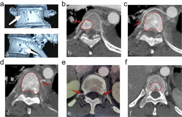 This composite of diagnostic images illustrates the vascular anatomy and tumoral blood supply of the vertebral column. Panel (a) presents 3D reconstructed CT images showing the anterior and lateral vertebral body surfaces, with white arrows indicating the entry points (pores) of nutrient arteries, including periosteal and metaphyseal rete-like branches. Panels (b) through (f) are axial contrast-enhanced CT scans of the thoracic vertebrae. Red arrows in (b) and (c) demonstrate nutrient arteries originating from the right segmental artery, while (d) shows an origin from the left. Panel (e) highlights bilateral segmental and spinal branches providing blood flow to the posterior vertebral body. Red outlines in (b, c, d, f) demarcate hypervascular metastatic spinal malignancies within the vertebral body, illustrating how specific segmental arterial branches provide nourishment to the tumor. These images serve as a clinical guide for understanding vertebral vascular territories (Zone 1 and 2) and planning preoperative arterial embolization to manage intraoperative bleeding in spinal oncology.