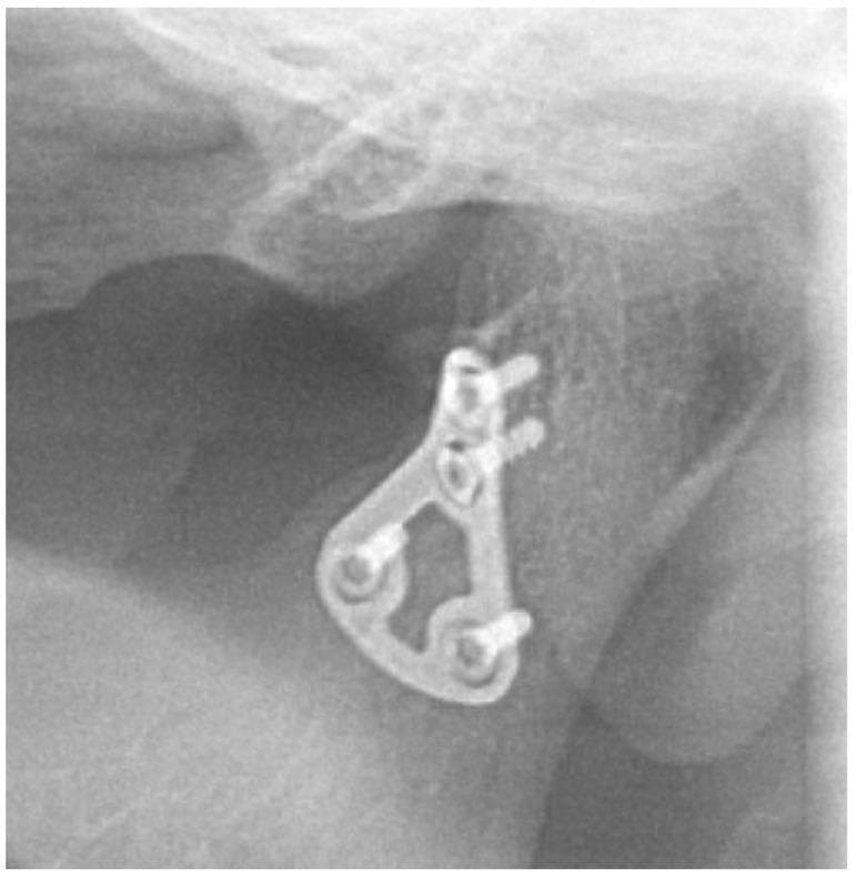A close-up X-ray (radiography) image demonstrating the internal fixation of a mandibular condyle fracture. The image shows a specialized 3D osteosynthesis miniplate, which is geometrically shaped and triangular with central cutouts to distribute mechanical stress. This metallic hardware is secured to the condylar process of the mandible using four radiopaque screws. The bone structure appears stable six months post-surgery, with the hardware properly positioned across the previous fracture site to facilitate bone union. No signs of screw loosening, plate migration, or hardware failure are visible. The surrounding bone density is relatively uniform, indicating successful healing without significant complications like malunion or sclerosis. This diagnostic image serves as a clinical example of uncomplicated maxillofacial trauma recovery following open reduction and internal fixation (ORIF) of the mandible.