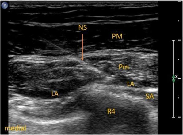 This diagnostic ultrasound image demonstrates a Pectoralis Nerves Block Type II (PECS II) being performed in the thoracic region. The image captures the regional anatomy in a transverse view, showing several muscular and skeletal layers. Visible structures include the pectoralis major (PM) as the most superficial muscle layer, followed by the pectoralis minor (Pm), and the serratus anterior (SA) located deeper and more laterally. The fourth rib (R4) is visible as a hyperechoic structure with posterior acoustic shadowing. A needle shaft (NS) is visualized using an in-plane technique, with its tip positioned to deliver local anesthetic (LA). The image clearly shows the distribution of local anesthetic in two key fascial planes: between the pectoralis major and minor muscles (the PECS I site) and between the pectoralis minor and serratus anterior muscles (the PECS II site). This image serves as an educational reference for ultrasound-guided regional anesthesia, specifically for postoperative analgesia in thoracic or breast surgeries.