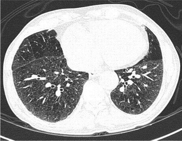 This diagnostic image is an axial non-contrast chest CT scan at the level of the lower lobes, demonstrating characteristic features of panacinar emphysema. The lung parenchyma exhibits a diffuse, generalized decrease in attenuation (hypodensity) bilaterally, resulting in a significantly darker appearance than normal lung tissue. Structurally, there is extensive destruction of the alveolar walls, leading to the formation of numerous small, round, and irregularly shaped airspaces that give the parenchyma a coarse, 'swiss cheese' or porous texture. Unlike centriacinar emphysema which typically affects the upper lobes, these changes are distributed uniformly across the visible lung segments without regional predilection. Key landmarks include the central mediastinum with a visible heart and descending aorta, and the bilateral major fissures. There is a notable absence of peripheral ground-glass opacities or consolidations, distinguishing this chronic obstructive pulmonary disease (COPD) manifestation from acute infectious processes like COVID-19 bronchopneumonia.