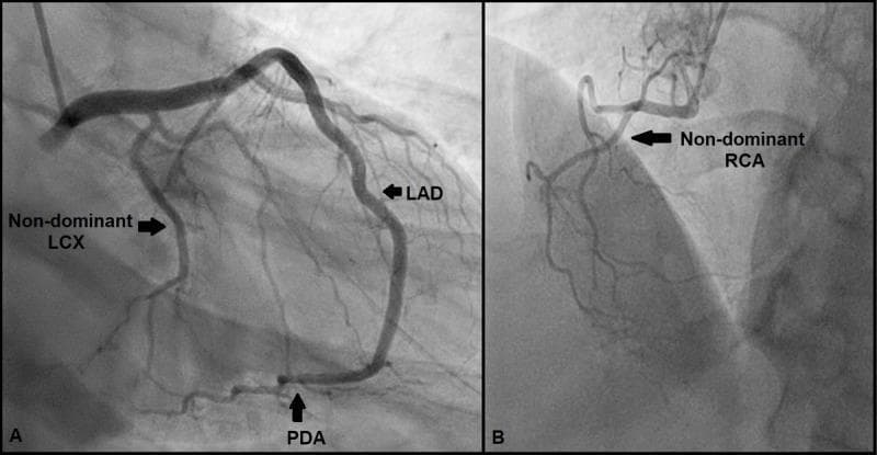 Diagnostic Imaging: These coronary angiograms illustrate a unique anatomical variation in cardiac coronary circulation dominance. Panel A, captured in a Right Anterior Oblique (RAO) with caudal angulation view, demonstrates a 'super-dominant' left anterior descending (LAD) artery. The LAD is seen wrapping around the left ventricular apex and continuing into the posterior interventricular groove to become the posterior descending artery (PDA), a territory typically supplied by the right coronary artery or left circumflex artery. A small, non-dominant left circumflex (LCX) artery is also visible. Panel B, in a Left Anterior Oblique (LAO) with cranial angulation view, shows a small, non-dominant right coronary artery (RCA) that does not reach the crux or provide the PDA. This image pair is an educational example of coronary anatomy variants, highlighting the LAD-to-PDA continuation in the absence of traditional RCA or LCX dominance. The findings demonstrate a rare left-dominant system where the LAD supplies the posterior diaphragmatic surface of the heart.