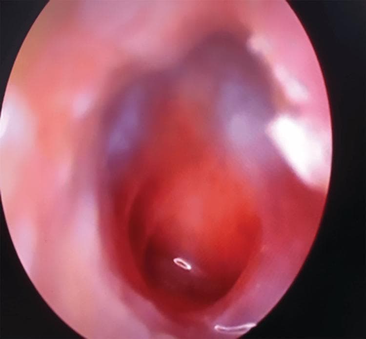 This clinical photograph, obtained via otoscopy/endoscopy, depicts a human tympanic membrane with a large central perforation. The perforation occupies a significant portion of the pars tensa, appearing as a dark, well-demarcated void that reveals the underlying middle ear space. The surrounding tympanic membrane remnant is erythematous and thickened, indicating active or chronic inflammation. The middle ear mucosa visible through the defect appears congested and reddish. Key anatomical landmarks, such as the handle of the malleus and the light reflex, are obscured or distorted due to the extensive tissue loss and inflammatory changes. This visual is characteristic of chronic suppurative otitis media (CSOM) or significant acoustic/mechanical trauma. The image serves as an educational example of middle ear pathology and the visual assessment of tympanic membrane integrity in an otolaryngology context.