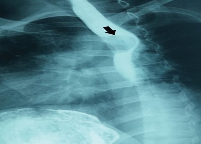 This diagnostic image is a barium swallow radiograph (upper GI series) showing the thoracic esophagus. The image demonstrates a well-defined, semilunar (half-moon shaped) filling defect in the upper thoracic esophagus, indicated by a black arrow. The defect has smooth, regular margins and causes a localized displacement of the contrast column, suggesting an intramural or extramural mass rather than an intraluminal primary mucosal lesion. The surrounding esophageal lumen remains patent but distorted. Relevant anatomical landmarks include the posterior ribcage and the distal trachea. Such findings are classically associated with benign esophageal tumors, such as leiomyomas, which present as smooth filling defects with obtuse angles to the esophageal wall. The image is an essential teaching tool for identifying esophageal filling defects and distinguishing between mucosal and submucosal pathologies in gastroenterology and radiology.