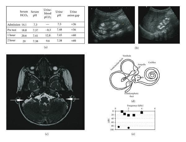 This composite educational image illustrates the clinical and diagnostic features of distal renal tubular acidosis (dRTA) associated with sensorineural hearing loss. (a) Data table showing results of a bicarbonate loading test, characterized by low urine-to-blood pCO2 gradient and positive urinary anion gap. (b) Renal ultrasound images of the left and right kidneys demonstrating medullary nephrocalcinosis, visualized as multiple hyperechoic foci within the renal pyramids. (c) Axial FIESTA (Fast Imaging Employing Steady-state Acquisition) cerebral MRI scan showing bilateral enlargement of the endolymphatic sacs (indicated by white arrows), a common finding in Pendred syndrome or dRTA with hearing loss. (d) Anatomical schematic of the inner ear, labeling the cochlea, vestibule, semicircular ducts, and endolymphatic duct. (e) Audiogram plot showing frequency (kHz) versus decibels (dB), depicting significant hearing impairment. The collection integrates metabolic laboratory data, diagnostic radiology (ultrasound and MRI), and functional audiological testing to present a comprehensive case of a hereditary renal-otological syndrome.