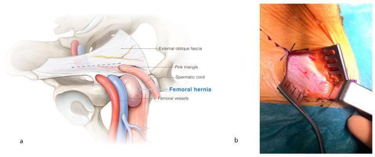 This dual-panel image provides an anatomical and clinical overview of a femoral hernia and its surgical exposure. Panel (a) is a detailed anatomical diagram of the right inguinal and femoral regions. It illustrates a femoral hernia as a distinct bulge emerging medially to the femoral vessels (artery and vein) and caudal to the inguinal canal. Labeled structures include the external oblique fascia, the 'pink triangle' (an area formed by the diversion of fascial vessels toward the external inguinal orifice), the spermatic cord, and femoral vessels. Panel (b) is a clinical photograph showing the intraoperative view after the incision of the external oblique fascia. The surgical field is exposed using three metal claw-style retractors, revealing the underlying fascia and fatty tissue in the femoral region. Sutures are visible along the superior aspect of the skin incision. This content is designed for medical education regarding hernia pathology and surgical repair, demonstrating the critical landmarks needed to differentiate femoral hernias from inguinal hernias and to safely navigate the femoral canal during surgery.