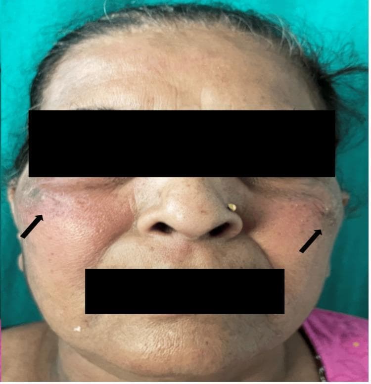 Clinical photograph of a 59-year-old female patient showing a characteristic malar rash. The image displays confluent, erythematous patches distributed over the bilateral cheeks and extending towards the temporal regions, as indicated by black arrows. The rash exhibits a symmetric, butterfly-like distribution, though the nasolabial folds appear relatively spared. The skin within the affected areas shows noticeable texture changes and erythema. Additional visible features include forehead rhytids, perioral lines consistent with age-related skin changes, and uneven pigmentation. The patient has a nose ring in the left nostril. The clinical presentation is consistent with cutaneous lupus erythematosus, specifically a drug-induced manifestation. The educational focus is on identifying classic dermatological signs of systemic inflammatory or drug-induced conditions through facial skin morphology and distribution patterns.