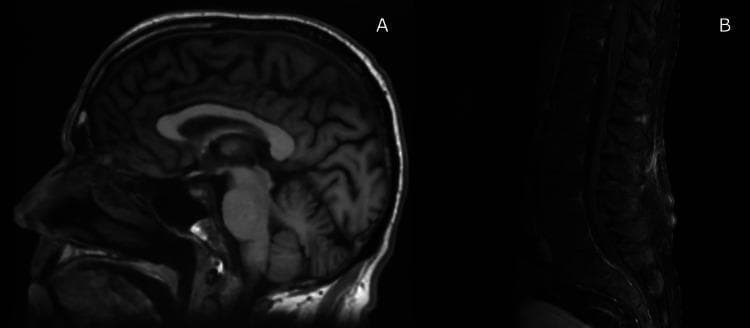 Diagnostic Imaging: This composite clinical image displays T1-weighted Magnetic Resonance Imaging (MRI) sequences of the central nervous system. Panel A features a sagittal view of the brain, demonstrating normal intracranial anatomy. Key visible structures include the cerebral cortex with preserved sulcation and gyration, the corpus callosum, the brainstem (pons and medulla), and the cerebellum. The brain parenchyma shows no evidence of masses, midline shift, or signal abnormalities. Panel B presents a sagittal MRI of the spinal column. The alignment of the vertebral bodies is preserved, and the intervertebral disc spaces appear intact. The spinal cord is clearly visualized within the spinal canal, showing no signs of extrinsic compression or significant nerve root thickening. While the clinical context mentions possible mild pial enhancement, the primary educational value of this image set lies in demonstrating baseline normal neurological imaging in a patient undergoing workup for demyelinating polyneuropathy (CIDP). These images serve as a reference for negative diagnostic findings in cases of progressive sensory-motor neuropathy.