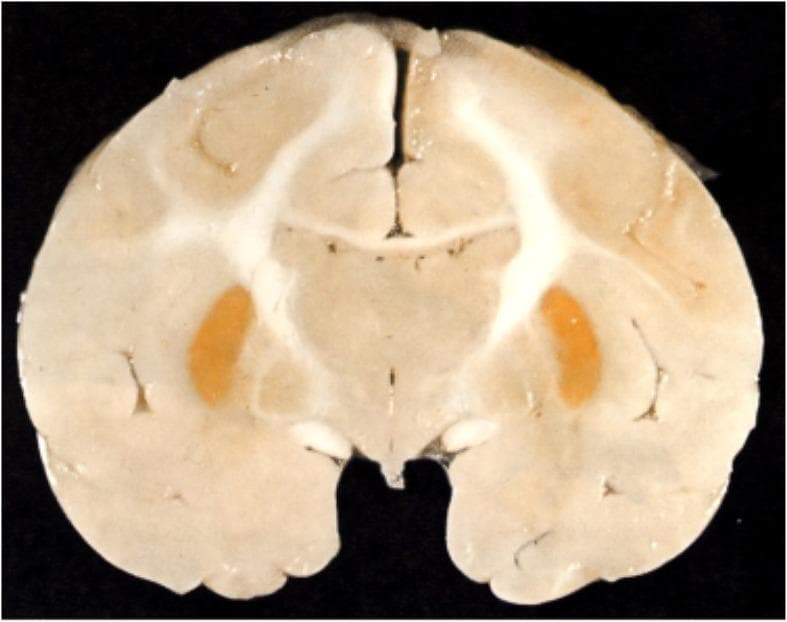 This clinical photograph displays a coronal gross section of a brain, serving as a classic pathological demonstration of kernicterus (bilirubin encephalopathy). The most striking visual feature is the intense, symmetrical yellow-orange staining (icterus) localized specifically to the basal ganglia, most notably the putamen. This discoloration results from the deposition of unconjugated bilirubin in specific subcortical nuclei. The surrounding cerebral cortex, white matter tracts, and ventricular spaces appear largely unaffected and maintain a normal pale cream coloration. This visual pattern is characteristic of neonatal jaundice where the blood-brain barrier is permeable to lipid-soluble unconjugated bilirubin, leading to localized neurotoxicity. The image highlights the selective vulnerability of deep gray matter structures to hyperbilirubinemia in the neonatal period, a key concept in pediatric neurology and pathology.