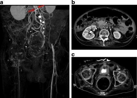 This diagnostic image composite includes a Computed Tomography Angiography (CTA) maximum intensity projection (MIP) in coronal view (a) and two axial contrast-enhanced CT slices (b, c) of the abdomen and pelvis. The images demonstrate Leriche syndrome, characterized by a complete occlusion of the infrarenal abdominal aorta. In panel (a), red arrows indicate the level of aortic termination immediately below the renal arteries. There is a bilateral absence of contrast opacification in the common, internal, and external iliac arteries, consistent with extensive aortoiliac occlusive disease. The right infrainguinal vessels are non-visualized, suggesting distal extension of the occlusion. Conversely, the left infrainguinal vessels (femoral artery) show patency, maintained via extensive collateral circulation. Panel (b) confirms the lack of contrast within the aortic lumen at the infrarenal level, while panel (c) shows the pelvic vascular distribution. These findings are clinically significant for evaluating acute or chronic limb-threatening ischemia and planning surgical or endovascular revascularization.