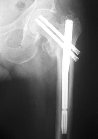 Anteroposterior (AP) X-ray of the proximal femur demonstrating internal fixation of an intertrochanteric fracture using a short cephalomedullary nail. The radiographic study shows a titanium alloy intramedullary nail positioned within the femoral shaft, secured proximally by two parallel cephalic lag screws extending into the femoral head to stabilize the fracture site. A single distal locking screw is visible at the inferior end of the nail to prevent rotation and axial displacement. The image displays acceptable closed reduction with evidence of radiographic healing, characterized by the continuity of the cortical bone and callus formation across the fracture line at the 4-month postoperative stage. Anatomical landmarks including the acetabulum, femoral head, and greater trochanter are clearly visible, illustrating the proper alignment and tip-apex distance of the orthopedic hardware for hip fracture management.