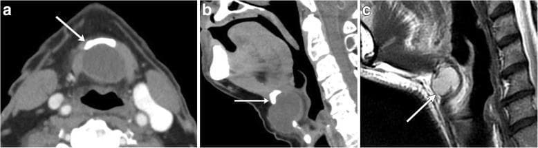 This composite figure displays diagnostic imaging of midline thyroglossal duct cysts (TGDC) using CT and MRI. Panels (a) axial and (b) sagittal contrast-enhanced CT images show a well-circumscribed, non-enhancing, hypoattenuating (fluid-density) cystic mass in the midline of the neck. The images highlight the classic relationship of the cyst to the hyoid bone (indicated by white arrows), with the sagittal view clearly demonstrating the cyst's position adjacent to the bone. Panel (c) provides a sagittal T2-weighted MR image from a different patient, where the lesion exhibits high signal intensity (bright), characteristic of fluid content. In this case, the arrow points to the hyoid bone, showing the cyst extending posterior to it. These images illustrate the typical presentation of a TGDC, emphasizing its midline location, cystic nature, and intimate association with the hyoid bone, which are critical diagnostic markers for this congenital anomaly. The imaging helps differentiate TGDCs from other neck masses like branchial cleft cysts or dermoids based on midline positioning and lack of internal solid components or fat.