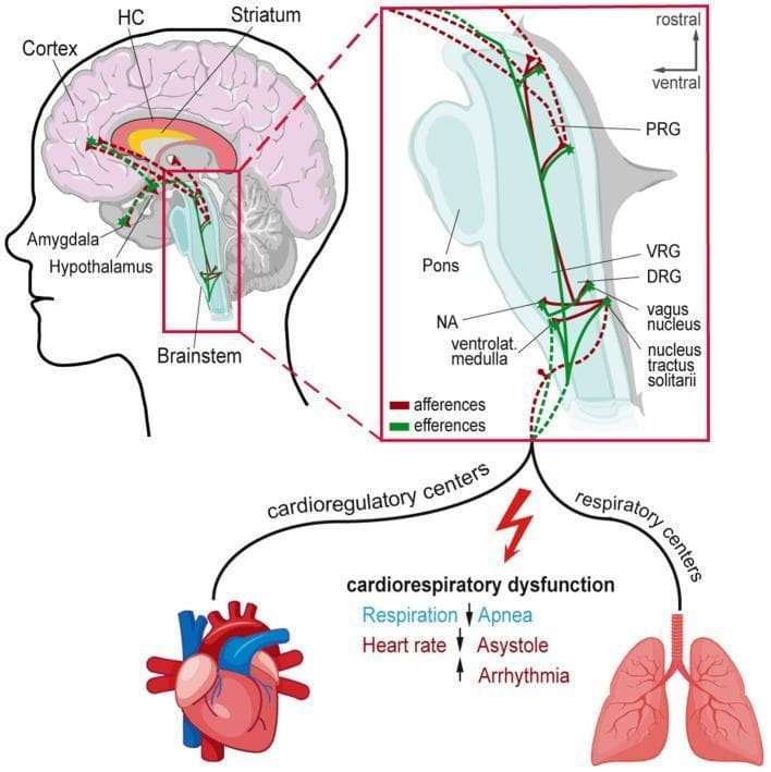 This pathophysiology diagram illustrates the neural circuitry and mechanisms of seizure-induced cardiorespiratory dysfunction leading to Sudden Unexpected Death in Epilepsy (SUDEP). The primary visual features a sagittal view of the human brain highlighting the cortex, striatum, hippocampus (HC), amygdala, and hypothalamus. Red (afferent) and green (efferent) pathways show connections between these higher cortical/limbic regions and the central autonomic network in the brainstem. A magnified inset of the brainstem details specific regulatory nuclei: the pontine respiratory group (PRG) in the pons, and the ventral respiratory group (VRG), dorsal respiratory group (DRG), nucleus ambiguus (NA), vagus nucleus, and nucleus tractus solitarii in the medulla. The diagram maps how seizure activity disrupts these cardioregulatory and respiratory centers, leading to peripheral autonomic failure. The lower section depicts the clinical outcomes of this dysfunction: apnea in the lungs, and asystole or arrhythmia in the heart, symbolized by a lightning bolt indicating acute cardiorespiratory collapse.