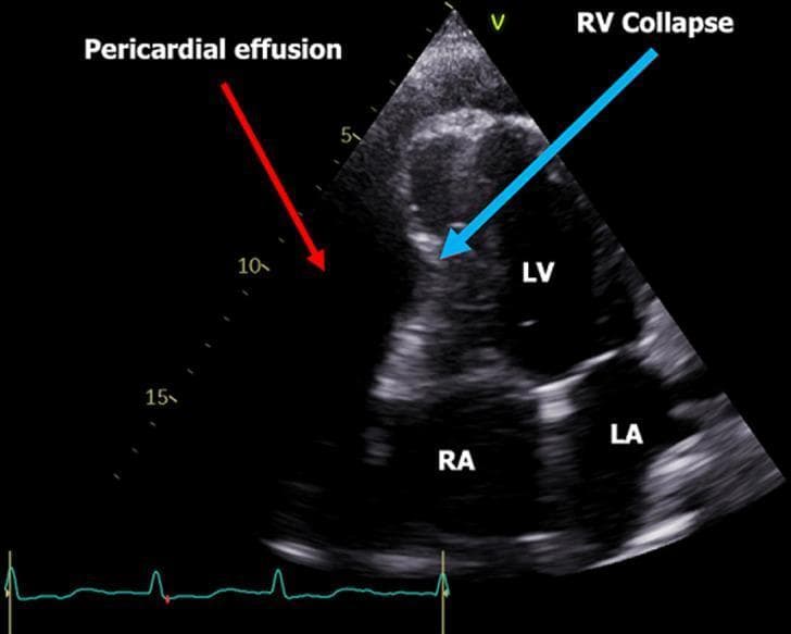 A two-dimensional transthoracic echocardiogram (TTE) in an apical four-chamber view demonstrating a large, circumferential pericardial effusion. The effusion appears as a prominent anechoic (dark) space surrounding the cardiac chambers, highlighted by a red arrow. All four chambers are labeled: Right Atrium (RA), Left Atrium (LA), Left Ventricle (LV), and Right Ventricle (RV). A blue arrow points to the RV, where the free wall shows inward compression or diastolic collapse, a hallmark sign of cardiac tamponade. The image includes a simultaneous electrocardiogram (ECG) tracing at the bottom, which shows sinus rhythm with relatively low voltage complexes. This diagnostic image is used to illustrate the hemodynamic impact of pericardial fluid on right-sided heart chambers, emphasizing the clinical significance of recognizing signs of tamponade physiology through bedside ultrasonography.