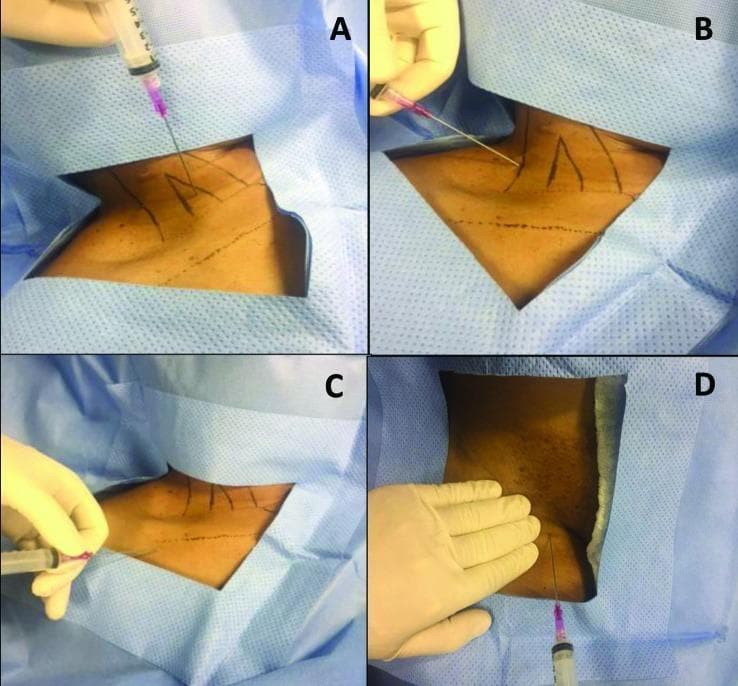A clinical photograph comprising four panels (A, B, C, D) demonstrating needle puncture techniques for deep vein access during central venous catheterization. Each panel shows a patient prepared with a sterile blue drape and a clinician wearing white sterile gloves using a 10 mL syringe containing pink-tinged fluid. Panel A illustrates an anterior approach to the internal jugular vein (IJV), with the needle inserted at the apex of the triangle formed by the sternal and clavicular heads of the sternocleidomastoid muscle. Panel B shows a posterior approach to the IJV, with the needle entering lateral and posterior to the sternocleidomastoid muscle. Panel C depicts infraclavicular puncture of the subclavian vein, with landmarks indicating insertion between the middle and lateral thirds of the clavicle. Panel D shows a femoral vein puncture in the groin region, medial to the palpated femoral artery pulse. Anatomical landmarks and projected pathways are indicated by black skin markings. These images illustrate common vascular access points used for implanting long-term medical devices like portacaths.