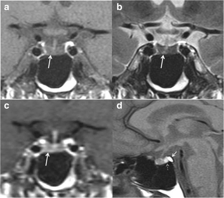 This diagnostic image set consists of four MRI views of the pituitary gland (sella turcica region). Panel (a) shows an unenhanced coronal T1-weighted image where the anterior pituitary displays a low-intermediate signal intensity. Panel (b) is a coronal T2-weighted view exhibiting significantly decreased signal (hypointensity) within the anterior gland. Panel (c) provides an early coronal T1-weighted image following intravenous contrast injection, demonstrating reduced and delayed enhancement of the pituitary parenchyma. Panel (d) shows an unenhanced sagittal T1-weighted view depicting a small (atrophic) anterior pituitary gland. Key landmarks include the normal hyperintense signal of the posterior pituitary (bright spot), the distinct hyperintensity of the fatty marrow in the dorsum sellae, and a normal-appearing pituitary stalk. These findingsโdiffuse hypointensity on T1 and T2 sequences with reduced gadolinium enhancementโare characteristic of infiltrative disorders such as pituitary amyloidosis, which can lead to panhypopituitarism.