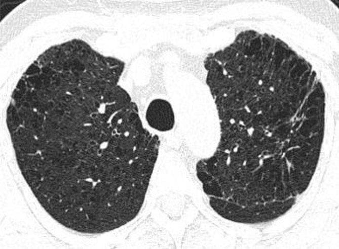 This diagnostic image is an axial non-contrast-enhanced CT scan of the chest at the level of the upper lobes, demonstrating significant chronic obstructive pulmonary disease (COPD) pathology. The lung parenchyma shows extensive centrilobular emphysema, characterized by multiple small, focal areas of low attenuation representing alveolar destruction within the secondary pulmonary lobules. Complementary paraseptal emphysematous changes are visible as subpleural lucencies along the peripheral lung margins. In the apicoposterior segment of the left upper lobe, there is a localized area of increased attenuation consistent with a fibrotic lesion or reticular opacity. The distribution is primarily bilateral and upper-lobe predominant, which is characteristic of smoking-related lung disease. Key educational concepts include the radiographic differentiation between centrilobular and paraseptal emphysema and the identification of concurrent interstitial lung changes in a patient with multi-faceted parenchymal disease.