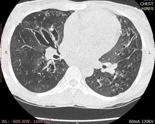 Axial high-resolution computed tomography (HRCT) of the chest demonstrating classic features of bronchiectasis. The primary findings include significant cystic and cylindrical bronchial dilatation, most prominent in the central lung fields. Notable bronchial wall thickening is present throughout, creating a 'tram-track' appearance in longitudinal sections and 'signet-ring' signs where dilated bronchi exceed the diameter of their accompanying pulmonary arteries. The lung parenchyma exhibits a mosaic attenuation pattern, characterized by patchy areas of ground-glass opacity interspersed with regions of decreased lung density, likely representing air trapping or mosaic perfusion. Additionally, multiple ill-defined pulmonary nodules of varying sizes are visible in a random distribution across both lung fields. These findings are clinically significant for chronic inflammatory airway disease, often seen in post-infectious bronchiectasis or cystic fibrosis.
