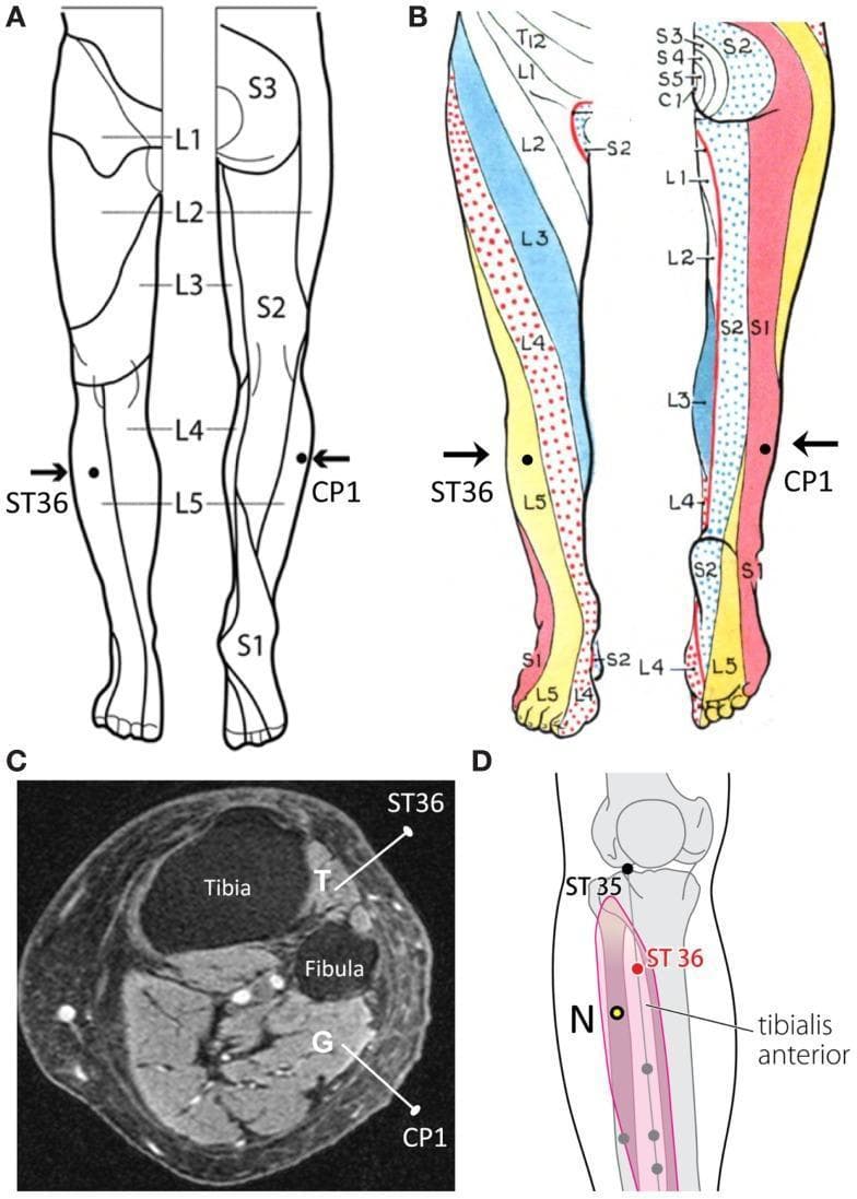 A multi-panel medical illustration and diagnostic image set concerning lower limb neuroanatomy and acupuncture point localization. Panels A and B present comparison charts of human dermatome maps of the lower extremity, highlighting variations in sensory innervation levels (L1-S3). Specifically, they demonstrate the positioning of acupuncture points ST36 (Zusanli) and a control point CP1. In map A, both points reside within the L5 dermatome, while in map B, CP1 is situated within the S1 dermatome. Panel C is an axial T1-weighted MRI of the right lower leg providing cross-sectional anatomical detail. It identifies the Tibia and Fibula bones, the Tibialis Anterior muscle (T) with a needle inserted at ST36, and the Gastrocnemius muscle (G) with a needle inserted at CP1. Panel D features an anatomical diagram of the proximal lower leg, illustrating the Tibialis Anterior muscle belly and suggesting an alternative control point (N) located posterior and inferior to ST36 within the same muscle and dermatome. This composite serves as an educational resource for studying the relationship between surface acupuncture points, deeper myotomal structures, and segmental dermatomal innervation.