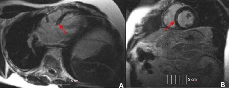 Cardiac Magnetic Resonance Imaging (MRI) demonstrating Late Gadolinium Enhancement (LGE) indicative of myocardial fibrosis or sarcoidosis. The image is divided into two panels: Panel A displays a horizontal long-axis (four-chamber) view of the heart, while Panel B shows a short-axis view at the basal-mid ventricular level. In both views, red arrows point to areas of linear, mid-myocardial hyperintensity (increased signal) located within the interventricular septum, specifically in the anterior basilar region. This pattern is characteristic of non-ischemic cardiomyopathy. The left ventricle in Panel B appears relatively circular with uniform wall thickness, while Panel A shows the relationship between the atria and ventricles. Each panel includes a 5 cm scale bar for anatomical dimensioning. The diagnostic focus is on identifying mid-wall delayed enhancement, which is a critical finding for assessing myocardial tissue characterization and infiltrative diseases like cardiac sarcoidosis.