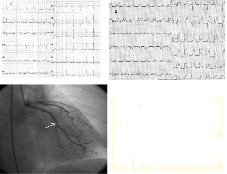 This composite figure presents a clinical case study of acute coronary syndrome through ECG comparison and invasive imaging. Panels 1 and 2 show 12-lead electrocardiogram (ECG) tracings. Panel 1 depicts a baseline sinus rhythm with normal repolarization. Panel 2, recorded during symptomatic chest pain, reveals significant ST-segment elevation in the high lateral (I, aVL) and precordial (V1-V6) leads, accompanied by hyperacute, tall, peaked T-waves, indicative of an acute anterolateral ST-elevation myocardial infarction (STEMI). Below the ECGs, a grayscale coronary angiogram (fluoroscopy) visualizes the left coronary artery system using radiopaque contrast. A white arrow points to a significant focal stenosis within the left circumflex coronary artery, specifically at the origin of the first marginal branch (Mg1). This visual combination illustrates the correlation between dynamic electrocardiographic changes during angina and the underlying obstructive coronary artery disease. The educational focus is on identifying acute ischemic patterns on ECG and their angiographic confirmation in the context of one-vessel coronary disease.