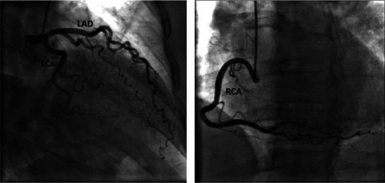 This diagnostic image is a coronary angiogram consisting of two panels demonstrating normal coronary anatomy. The left panel shows the left coronary system with labeled Left Anterior Descending (LAD) and Left Circumflex (LCx) arteries. The LAD is seen coursing anteriorly and inferiorly, giving off diagonal branches, while the LCx travels within the atrioventricular groove, exhibiting normal tapering and branching without evidence of luminal narrowing, stenosis, or occlusion. The right panel illustrates the Right Coronary Artery (RCA) in a characteristic 'C' shape, originating from the right coronary sinus and extending along the posterior interventricular groove. The RCA appears smooth with patent distal flow and visible side branches. This invasive imaging study serves as a clinical reference for angiographically normal epicardial coronary arteries, typically used in cardiology and radiology to rule out obstructive coronary artery disease (CAD) or vasospastic disorders in the setting of chest pain or ischemic ECG changes.