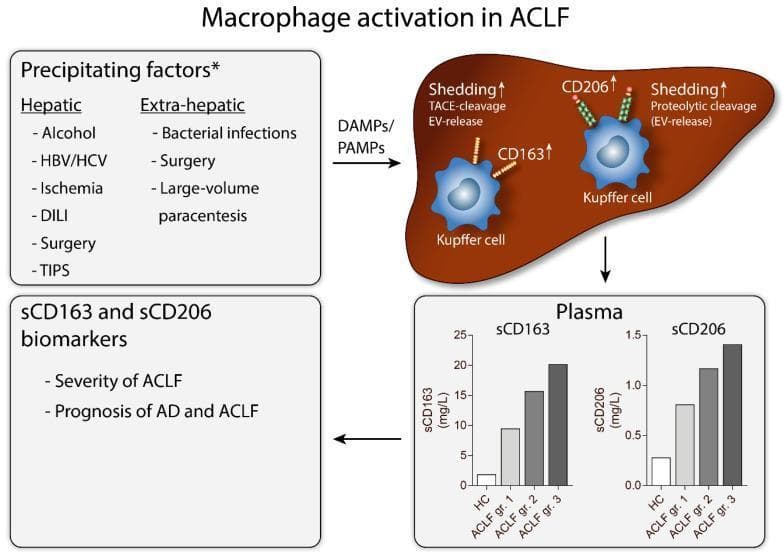 This medical infographic illustrates the pathophysiology of macrophage activation in Acute-on-Chronic Liver Failure (ACLF). The diagram depicts hepatic (e.g., alcohol, HBV/HCV, DILI) and extra-hepatic (e.g., bacterial infections, surgery) precipitating factors that trigger the release of PAMPs and DAMPs. These molecules activate liver resident macrophages, or Kupffer cells. Within the liver, the diagram shows upregulated expression and increased shedding of membrane-bound CD163 and CD206 from Kupffer cells. The shedding of CD163 occurs via TACE-cleavage and extracellular vesicle (EV) release, while CD206 is shed via proteolytic cleavage and EV-release. Two bar graphs demonstrate the clinical significance of these processes, showing a stepwise increase in plasma concentrations of soluble CD163 (sCD163) and soluble CD206 (sCD206) correlating with ACLF severity (Healthy Control vs. Grades 1-3). The infographic identifies sCD163 and sCD206 as prognostic biomarkers for disease severity and mortality in patients with acute decompensation (AD) and ACLF, highlighting their role in monitoring hepatology patients.