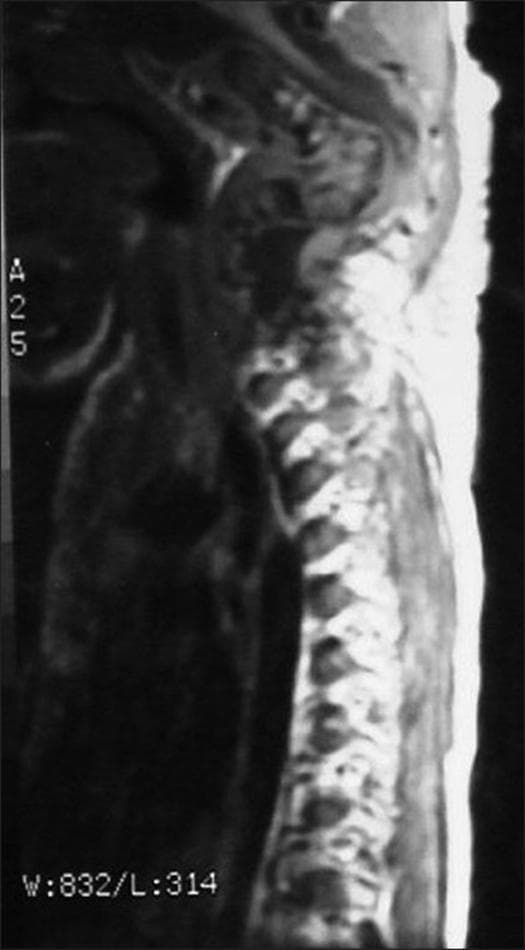 This sagittal T2-weighted MRI image of the cervical spine reveals a severe kyphotic deformity centered at the C2-C4 levels. The normal cervical lordosis is completely replaced by an acute, angular kyphosis of approximately 120 degrees. The spinal alignment is markedly disrupted, consistent with spondyloptosis, where the vertebral bodies have translated significantly, creating a sharp bony apex. The spinal cord is visually stretched and tightly compressed over this bony prominence at the apex of the deformity. There is an evident loss of the normal cerebrospinal fluid (CSF) signal surrounding the cord at the site of maximum narrowing, indicating critical spinal stenosis. The surrounding soft tissues and vertebral body morphologies appear altered by this chronic malalignment. This diagnostic image is representative of advanced neurological compromise due to spinal instability and serves as a classic illustration of severe kyphotic spinal cord compression.