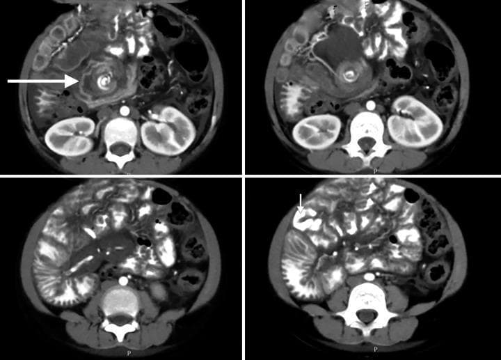 This medical image is a series of four axial slices from a contrast-enhanced abdominal computed tomography (CT) scan illustrating midgut malrotation with volvulus. Key diagnostic features include the 'whirlpool sign' (indicated by a large white arrow), which demonstrates the twisting of the mesenteric vessels and mesentery around the base of the superior mesenteric artery. The duodenojejunal flexure is abnormally positioned on the right side of the spine instead of the left. Additionally, the jejunal loops, identified by their internal iodinated contrast (noted by a smaller arrow), are predominantly located in the right hemiabdomen rather than the left upper quadrant. These findings collectively indicate a failure of normal intestinal rotation and subsequent midgut volvulus, which can lead to intestinal ischemia. The image is a classic example used in pediatric radiology to demonstrate surgical emergencies related to congenital intestinal anomalies.
