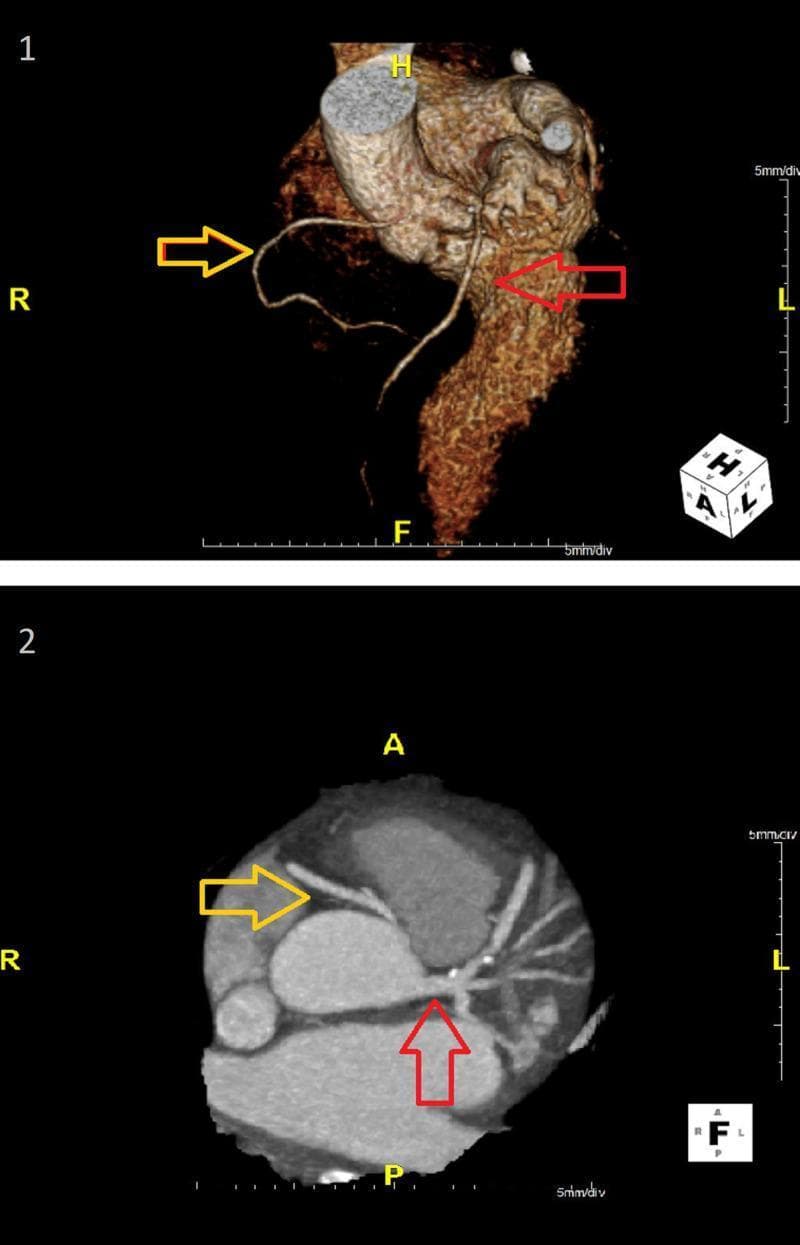 Two-panel diagnostic imaging showcasing cardiac anatomy via CT coronary angiography. Panel 1 features a 3D volume-rendered reconstruction of the heart and aorta, highlighting the spatial relationship of the coronary vasculature. Panel 2 presents an oblique maximum intensity projection (MIP) providing a cross-sectional view of the aortic root and arterial origins. The images demonstrate a congenital anomaly: an anomalous origin of the right coronary artery (RCA) from the left coronary sinus (ARCA-LCS). The yellow arrows indicate the RCA, which originates from the left sinus and follows an interarterial course between the aorta and pulmonary artery. The red arrows indicate the left coronary artery (LCA), also originating from the left sinus. This visual illustrates a high-risk coronary anomaly where the interarterial course can lead to mechanical compression of the vessel during physical exertion, which is a critical finding for cardiovascular risk assessment in clinical practice.