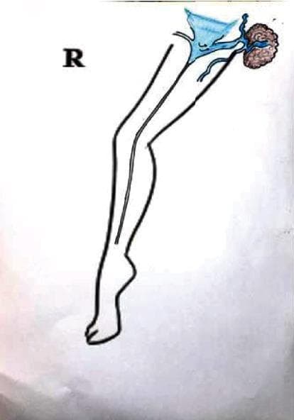 This medical schematic illustrates the vascular anatomy of the right lower extremity, focusing on mechanisms for the recurrence of varicose veins in the groin region. The diagram depicts the outline of a leg with a primary vertical vessel, representing the great saphenous vein (GSV), extending from the foot to the thigh. In the inguinal (groin) area, specifically within Scarpa's triangle, the illustration highlights a complex vascular network in blue. Key components include a triangular-shaped structure representing the saphenofemoral junction or a venous confluence, and a brown, textured cluster representing a lymph node. Small blue vessels are shown interconnecting the lymph node with the main venous system, demonstrating lymphatic-venous communication. The diagram serves an educational purpose by visualizing how accessory lymph node vessels can serve as pathways for venous reflux, leading to recurrent varicosities after surgical or endovenous treatments like radiofrequency ablation (RFA). This clinical illustration is designed for vascular surgery and phlebology education.