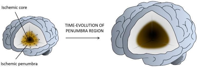 This medical illustration depicts the pathophysiology and progression of ischemic stroke within the brain, focusing on the concept of the penumbra. The diagram shows two cross-sections of the brain in a temporal sequence labeled 'TIME-EVOLUTION OF PENUMBRA REGION'. In the initial stage, an 'Ischemic core' (infarcted, irreversibly damaged tissue) is shown as a small, dark central focal point, surrounded by a larger 'Ischemic penumbra' (salvageable, hypo-perfused tissue) represented in a lighter shade. Radiating arrows from the core toward the penumbra indicate the dynamic expansion of injury. The subsequent illustration shows the final state where the ischemic core has significantly expanded, encompassing the majority of the original penumbra region, which characterizes the maturation of a cerebral infarct. This visualization serves as a neuroscientific model to explain the critical time-window for reperfusion and neuroprotective therapies aimed at rescuing salvageable brain tissue before it converts to permanent infarction.