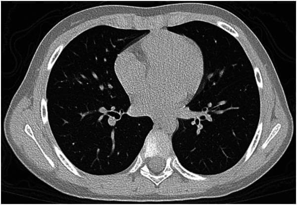 This unenhanced axial chest CT scan demonstrates a focused area of ground-glass opacity (GGO) located within the right middle lobe of the lung in a pediatric patient. The pathology is characterized by a hazy increase in lung density that does not obscure the underlying bronchovascular structures, indicative of partial filling of air spaces or interstitial thickening. The mediastinum, including the heart and great vessels, appears normal in size and position for the patient's age. No evidence of dense consolidation, pleural effusion, or lymphadenopathy is visible at this level. The finding is typical of a mild viral pneumonia, such as that seen in SARS-CoV-2 (Omicron variant) infections, and is consistent with a low CT severity score. This image serves as a clinical example of early or mild pulmonary involvement in viral respiratory diseases, highlighting the importance of identifying subtle GGOs in diagnostic radiology.