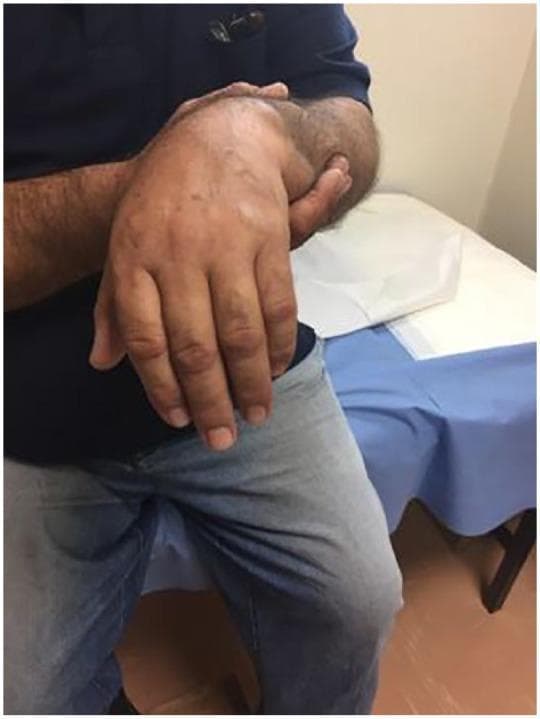 A clinical photograph of a male patient demonstrating 'wrist drop' or 'drop hand,' a classic sign of radial nerve palsy. The patient's right hand is shown held in a characteristic posture where the wrist is flexed downward and cannot be actively extended against gravity. The fingers are in a state of passive flexion at the metacarpophalangeal and interphalangeal joints, giving the hand a limp, flaccid appearance. The skin of the forearm and hand appears normal in color and texture, with no obvious swelling or ecchymosis visible in this view. This clinical manifestation is frequently associated with trauma, such as humeral fractures or shoulder dislocations that result in compression or injury to the radial nerve. The image serves as a high-yield educational resource for identifying peripheral nerve injuries during a neurological or orthopedic examination.