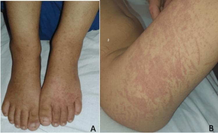 Two-panel clinical photograph illustrating the progression of vascular purpura in a pediatric patient. Panel A shows the dorsal aspect of both feet and lower legs featuring scattered, non-blanching, reddish-purple petechiae and small purpuric macules. Mild bilateral dependent edema is visible around the ankles. Panel B demonstrates the extension of the rash on the third day of admission, located on the thigh. This panel shows more confluent and larger purpuric patches with a distinctive reticular or livedoid pattern, characterized by net-like erythematous streaks and mottled discoloration. The lesions are typical of Henoch-Schönlein purpura (IgA vasculitis), demonstrating orthostatic distribution and evolution from discrete spots to confluent plaques. No secondary changes like ulceration or scaling are observed. The images serve as a teaching tool for recognizing small-vessel vasculitis morphology and its clinical evolution in pediatric dermatology and rheumatology.
