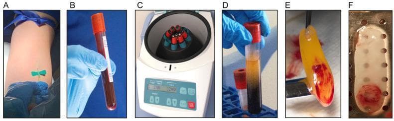 This clinical photograph panel illustrates the sequential clinical and laboratory steps for isolating Leukocyte- and Platelet-Rich Fibrin (L-PRF) for regenerative medicine. Panel A shows venous blood harvesting using a butterfly needle and tourniquet. Panel B displays a collected whole blood sample in a silica-coated glass tube. Panel C depicts the centrifugation process in a laboratory centrifuge (Hettich EBA-200), essential for component separation without anticoagulants. Panel D shows the post-centrifugation blood tube demonstrating distinct stratification: an upper layer of acellular plasma, a concentrated L-PRF clot in the middle, and packed red blood cells at the bottom. Panel E captures the manual isolation of the dense, yellowish L-PRF clot using sterile forceps. Finally, Panel F shows the resulting L-PRF membrane after mechanical compression in a surgical box, appearing as a flattened, whitish, resilient fibrin scaffold. This series serves as a protocol guide for clinicians in dental, maxillofacial, and orthopedic specialties to prepare autologous bioactive membranes for wound healing and tissue engineering.