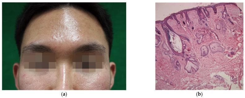 This composite image illustrates the clinical and histological features of facial seborrhea. Panel (a) is a clinical photograph of a young male's face, demonstrating characteristic greasy skin and prominent surface shine on the forehead and nose, indicative of excessive sebum production. Enlarged facial pores (ostia) are clearly visible on the cheeks. Panel (b) provides a correlating histological view of facial skin (nasal region) stained with hematoxylin and eosin (H&E) at x50 magnification. Key microscopic findings include multiple lobules of mature, hypertrophic sebaceous glands located in the dermis. A significantly dilated follicular infundibulum is observed, filled with lamellated keratinous material and sebum. This educational material highlights the relationship between macroscopic 'oily skin' and the underlying hyperactive pilosebaceous unit, a common factor in the pathogenesis of acne vulgaris and seborrheic dermatitis.