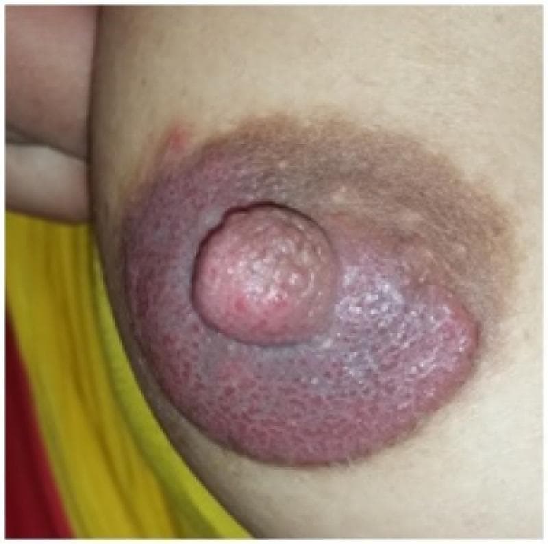 This clinical photograph displays a close-up view of the right female breast, focusing on the nipple-areolar complex (NAC). The primary finding is prominent erythematous hyperkeratosis of the areola and nipple. The affected area exhibits diffuse redness and a thickened, irregular, and verrucous texture, with visible scaling and crusting indicative of chronic inflammation. The nipple itself appears enlarged and edematous with surface cobblestoning. A distinct hyperpigmented ring borders the erythematous zone, and there are subtle indications of nipple discharge. These visual manifestations are characteristic of inflammatory or infectious conditions of the breast skin, such as cutaneous candidiasis or mammary Paget's disease. In the documented clinical context of a breastfeeding mother with a history of recurrent yeast infections, the image demonstrates the clinical presentation of areolar hyperkeratosis secondary to a Candida albicans infection. The image serves as an educational reference for dermatological and obstetric evaluation of infectious mastitis and associated skin lesions during lactation.