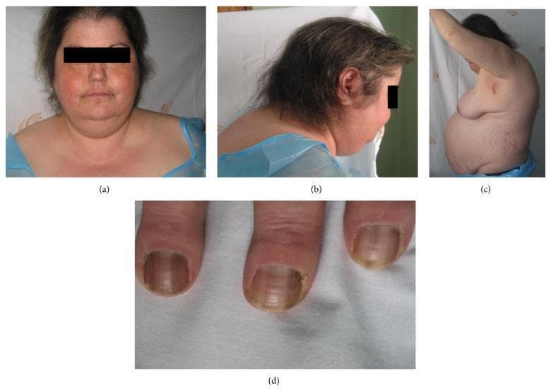A composite of four clinical photographs demonstrating the classic physical manifestations of Cushing's syndrome. Image (a) is a frontal view of the face showing 'moon facies' characterized by facial rounding and plethora. Image (b) provides a lateral view of the upper back and neck, highlighting a prominent dorsocervical fat pad (buffalo hump). Image (c) shows a profile of the torso, illustrating centripetal obesity and wide, purplish striae distensae along the abdomen and flanks. Image (d) is a close-up of the fingernails, displaying hyperpigmentation and longitudinal ridging, which may suggest associated adrenocorticotropic hormone (ACTH) excess. The collection serves as an educational reference for medical students to identify systemic signs of hypercortisolism, including skin atrophy and telangiectasias.