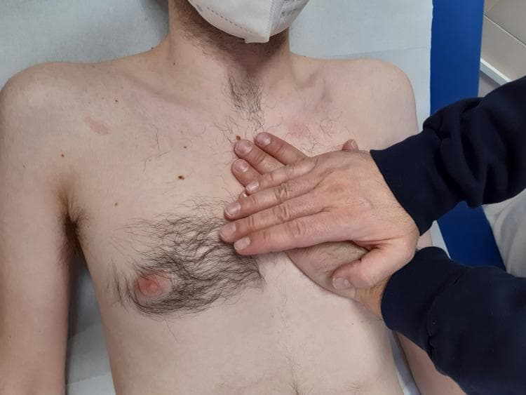 A clinical photograph depicts a procedural technique in osteopathic or physical assessment of the thoracic region. A patient is positioned supine on a medical examination table, with a clinician's hands performing palpatory listening over the precordium (heart area). The primary 'listening' hand is placed flat against the patient's upper-left chest, while the second hand is placed directly over the first to apply gentle, controlled pressure. This hand placement corresponds to the anatomical location of the heart and pericardium within the mediastinum. The patient’s chest exhibits fair skin with scattered nevi (moles) and terminal hair distribution concentrated around the nipple and upper sternum. The patient is wearing a white medical mask. The image serves as an educational resource for medical and osteopathic training, illustrating the correct hand positioning for evaluating fascial mobility, rhythmic impulses, or tissue compliance in the cardiac region.