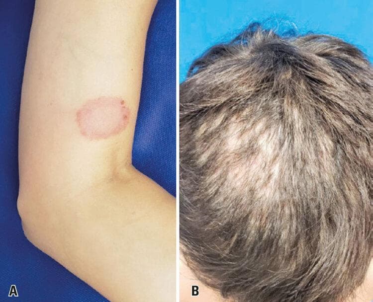 This composite clinical photograph displays two dermatological manifestations of fungal infection (dermatophytosis). Image A shows a classic presentation of tinea corporis on the left upper limb. The lesion is a well-circumscribed, erythematous, annular (ring-shaped) patch with a raised, inflammatory border and central clearing, characteristic of a fungal skin infection. Image B demonstrates a more severe involvement of the scalp (tinea capitis) in a pediatric patient. It reveals diffuse thinning of the hair and significant areas of non-scarring alopecia, particularly in the frontoparietal region. The scalp shows signs of underlying inflammation and scaling. These images illustrate the zoonotic transmission of Trichophyton mentagrophytes, showing both the common 'ringworm' presentation in an adult and a more extensive scalp involvement leading to hair loss in a child. This material is useful for teaching clinical recognition of dermatophytosis and its varied presentations across different anatomical sites and age groups.