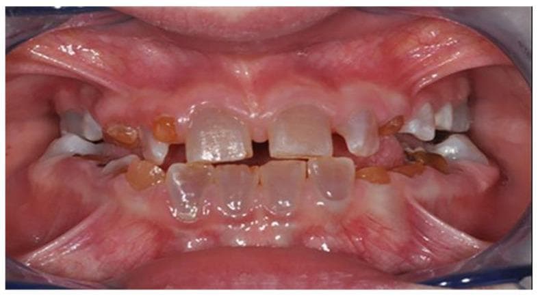 This intraoral clinical photograph showcases the dental manifestations of dentinogenesis imperfecta (DI) in a patient with Osteogenesis Imperfecta (OI). The primary findings include significant dental dyschromia, with the dentition exhibiting a characteristic opalescent, blue-grey to yellowish-brown translucent appearance. This discoloration results from the underlying defective dentin structure visible through the enamel. Structurally, the teeth show evidence of attrition and wear on the incisal and occlusal surfaces. The photograph also demonstrates clinical signs of increased enamel fragility, with apparent chipping and fractures. Malocclusion and irregular spacing are evident across both the maxillary and mandibular arches. This image serves as an educational example of how systemic connective tissue disorders, specifically OI, can impact dental development and lead to the clinical diagnosis of hereditary dentin defects.