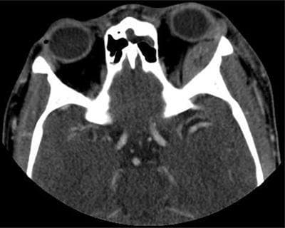 This diagnostic image is an axial contrast-enhanced CT scan of the orbits and skull base. The primary finding is a well-defined, biconcave or lens-shaped extraconal mass located along the superolateral wall of the left orbit. The lesion displays high attenuation, which is characteristic of acute hemorrhage (subperiosteal hematoma) or dense proteinaceous material. This mass exerts a mass effect on the adjacent intraorbital structures, resulting in slight proptosis. The contralateral (right) orbit and its contents appear normal. The bony margins of the frontal and sphenoid bones in this section appear intact without evidence of destructive lesions or gross fractures. Centrally, the ethmoid sinus and the anatomical structures of the skull base are visible. In the clinical context of sickle cell disease, this appearance is highly suggestive of a subperiosteal orbital hematoma, likely occurring secondary to bone infarction. The image serves as an educational example of orbital pathology and the radiological presentation of acute subperiosteal collections in the setting of hematological disorders.