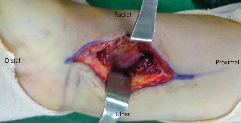 This clinical photograph demonstrates an intraoperative view of a conventional Henry approach to the distal radius. The image shows a longitudinal surgical incision on the volar aspect of the wrist, with the skin edges marked in blue. The surgical field is exposed using two metallic retractors (Senn or Army-Navy type) placed at the radial and ulnar borders of the wound. Anatomical orientation is explicitly labeled: Distal (left/hand), Proximal (right/forearm), Radial (top), and Ulnar (bottom). Deep to the skin and subcutaneous fat (yellowish tissue), the dissection exposes deeper muscular and fascial layers (reddish-pink tissue). This approach is specifically characterized by dissection between the flexor carpi radialis (FCR) tendon and the radial artery, intentionally sparing the FCR tendon sheath to minimize postoperative adhesions and maintain the integrity of the tendon's gliding mechanism. This visual is intended for orthopedic surgical education regarding volar distal radius fracture fixation.