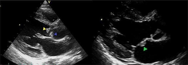 Two-panel diagnostic echocardiography (ultrasound) images demonstrating infective endocarditis with multiple vegetations on the left heart valves. The left panel shows a parasternal long-axis view of the bicuspid aortic valve, with hyperechoic, irregular masses (vegetations) attached to the tips of the anterior (yellow arrow) and posterior (blue arrow) leaflets. The right panel highlights the mitral valve apparatus, where another distinct hyperechoic vegetation is visible on the body of the anterior mitral valve leaflet (green arrow). These findings are highly suggestive of active infective endocarditis, illustrating the characteristic appearance of mobile, irregular echoes attached to valvular endocardial surfaces. Clinical relevance includes the high risk of systemic embolization given the size and location of these vegetations, commonly associated with pathogens such as Streptococcus gordonii. This visual serves as an educational tool for identifying valvular pathology, measuring vegetation dimensions, and assessing the risk of secondary complications like septic emboli in a cardiothoracic or infectious disease context.