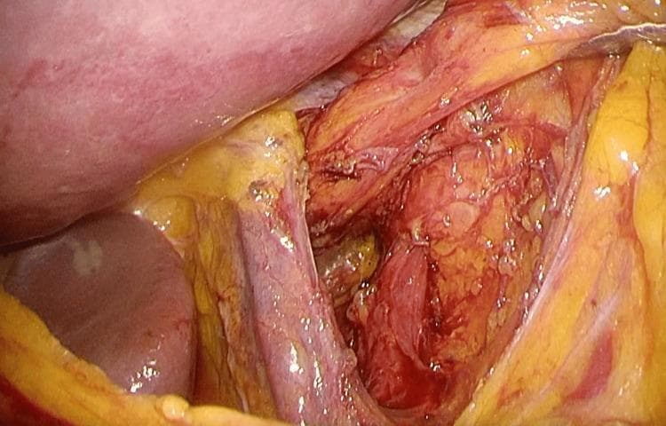 This intraoperative clinical photograph shows an open abdominal surgical field focused on the upper gastrointestinal region. The image demonstrates a pathologically enlarged esophageal hiatus, serving as a hernial orifice. Visible anatomical structures include the liver (smooth, reddish-brown organ on the left), the diaphragm, and the esophagus/stomach junction area. The operative field is characterized by moist, glistening visceral surfaces with exposed reddish muscular tissue and yellow adipose (fatty) tissue. The esophageal hiatus appears as a distinct, abnormally wide opening formed by the diaphragmatic crura. There is evidence of surgical dissection and manipulation of the surrounding tissues to expose the hiatal defect. This image illustrates a case of esophageal hiatal hernia where the orifice is sufficiently large to allow the herniation of abdominal viscera, such as the small intestine, into the thoracic cavity. The pathology is clinically relevant for understanding diaphragmatic hernia repair and the anatomical landmarks involved in cruroplasty.