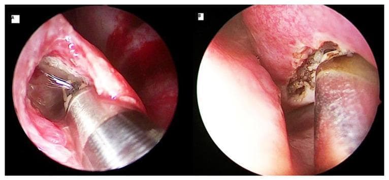 This composite diagnostic image features two endoscopic clinical photographs (A and B) demonstrating coblation turbinoplasty techniques for the treatment of inferior turbinate hypertrophy. Image A illustrates an intraturbinoplasty (submucosal) approach, showing a metallic coblation wand with a wire-like tip inserted into a submucosal channel of the inferior turbinate. The surrounding nasal mucosa is pink and intact, with minimal visible bleeding at the entry site. Image B illustrates an extraturbinoplasty (surface ablation) approach, where the coblation instrument is applied directly to the mucosal surface. The surgical site in B shows visible tissue disruption, charring, and thermal ablation effects, characterized by a brownish, irregular texture on the lateral aspect of the turbinate. Both images highlight the use of radiofrequency energy to reduce turbinate volume. This material is intended for otolaryngology surgical training, specifically demonstrating different technical applications of plasma-mediated ablation in endoscopic endonasal surgery.